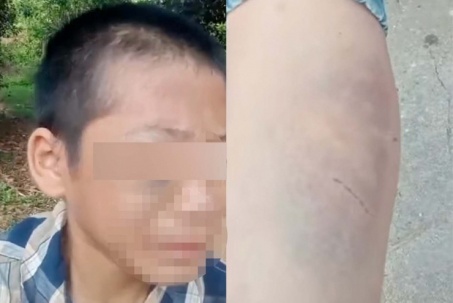 Cháu bé bầm tím khắp người ở Nghệ An: Công an vào cuộc xác minh