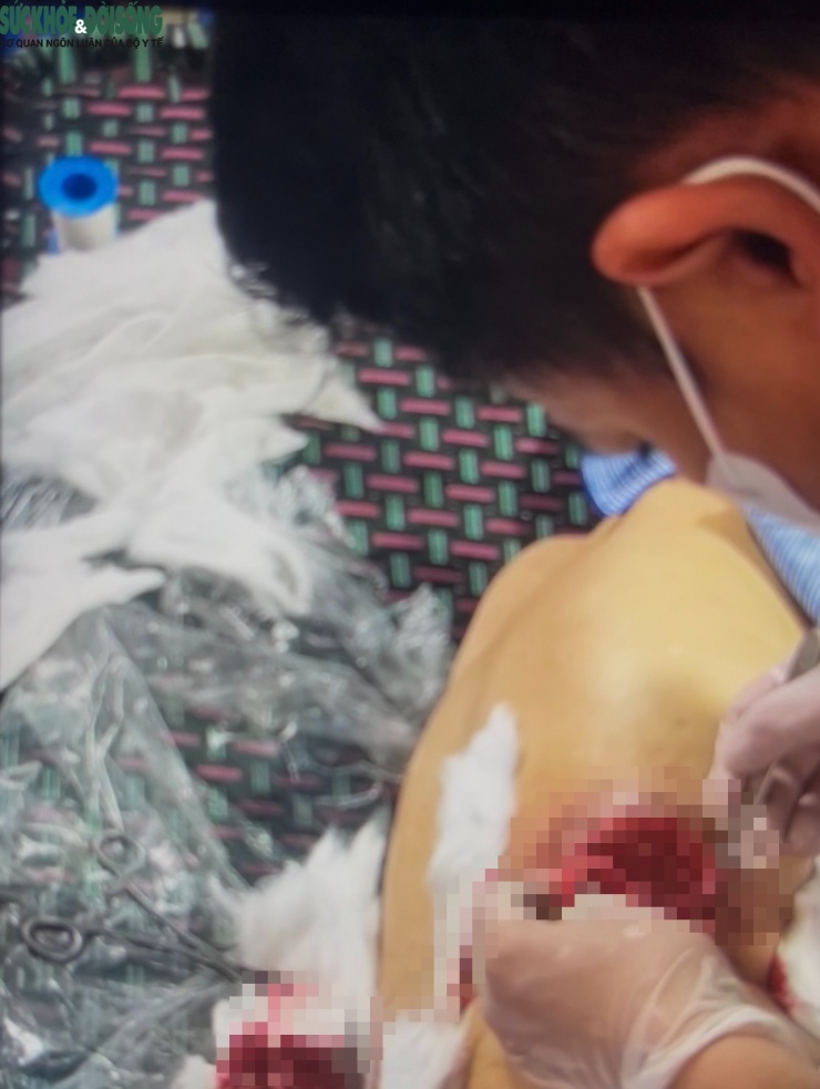 Sau cùng, ông Tuân dùng dao cắt bỏ từng phần mô tổn thương, rồi băng bó lại vết thương.