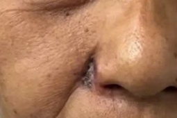 Tưởng nốt ruồi thông thường, người phụ nữ bị ung thư phá hủy toàn bộ cánh mũi