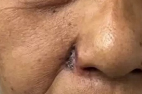 Tưởng nốt ruồi thông thường, người phụ nữ bị ung thư phá hủy toàn bộ cánh mũi