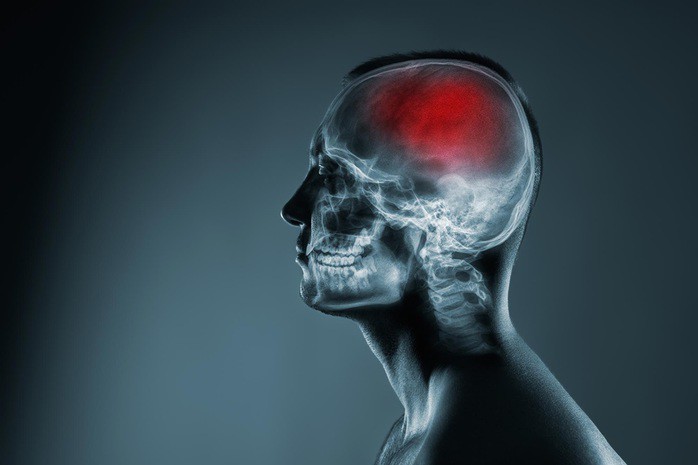 Nguyên nhân của một loại đột quỵ vừa được làm rõ. Ảnh minh họa: SCITECH DAILY
