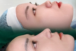 Các yếu tố quyết định một ca phẫu thuật nâng mũi an toàn và đẹp tự nhiên
