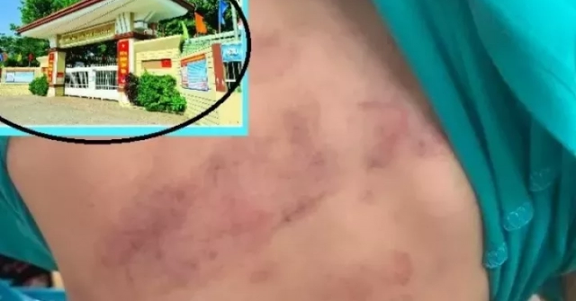 Học sinh lớp 1 bị bạn đánh hội đồng, phụ huynh bức xúc vì con phải chuyển lớp