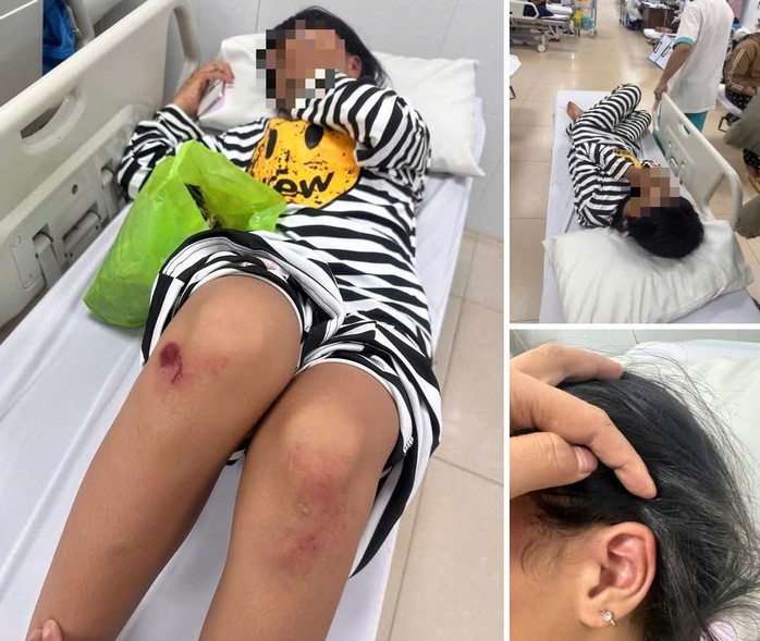 Bị nhóm bạn đánh bầm dập, nữ sinh lớp 6 phải nhập viện điều trị