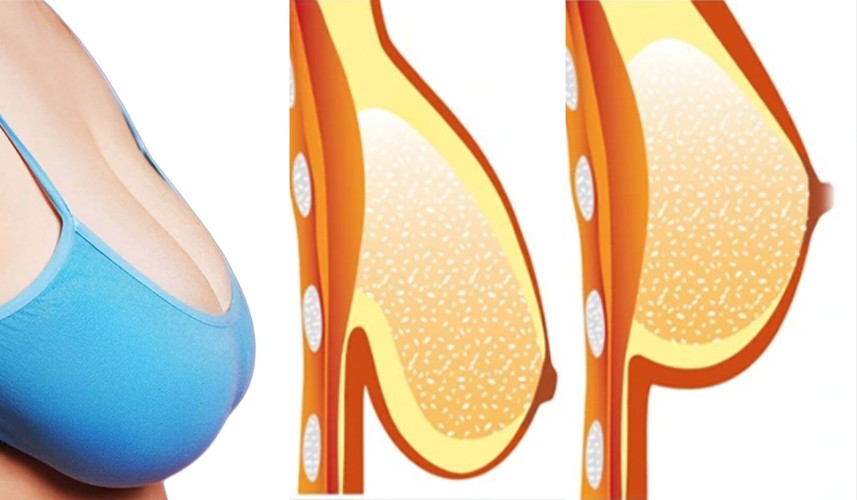 Sau sinh, giảm cân hoặc lão hóa là những nguyên nhân khiến ngực chảy xệ thường gặp.
