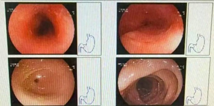 Hình ảnh chụp thực quản Wang bị loét do ăn lẩu nóng và nhanh. Ảnh: Sina