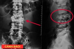 Tin tức sức khỏe - 5 thói quen tàn phá xương khớp cực nhanh, nên bỏ càng sớm càng tốt