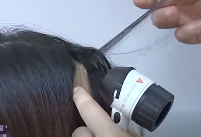 Thăm khám cho bệnh nhân rụng tóc cả mảng tại Bệnh viện Da liễu Trung ương