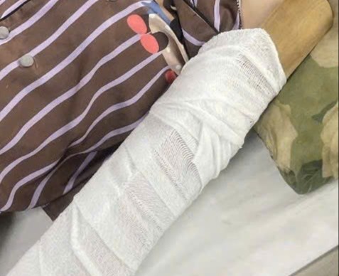 Vụ việc khiến cô gái bị gãy tay đang phải điều trị tại Bệnh viện Đa khoa Bình Dương. Ảnh: Bạn đọc cung cấp