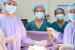 Hy hữu: Phẫu thuật lấy con lươn dài 50 cm chui vào bụng một bệnh nhân