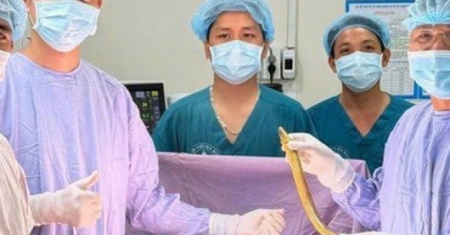 Hy hữu: Phẫu thuật lấy con lươn dài 50 cm chui vào bụng một bệnh nhân