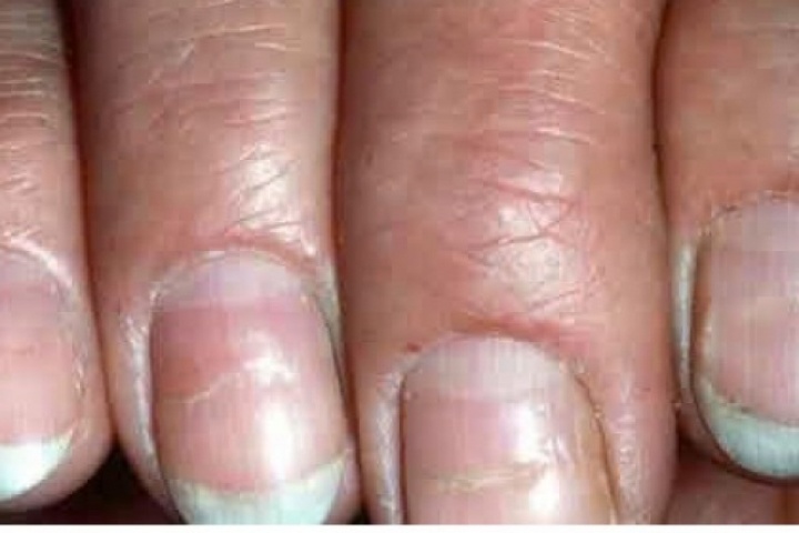 Nhìn móng tay biết bệnh? 6 dấu hiệu cảnh báo sức khỏe bạn không nên bỏ qua