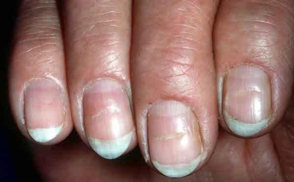 Vết lõm (đường Beau) nằm ngang móng tay