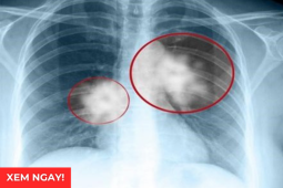 Tin tức sức khỏe - Tư thế ngủ tốt nhất cho phổi giúp giảm đàm ho rõ rệt, thở dễ hơn: Nhiều người đang làm sai!