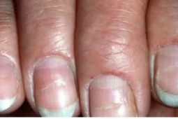 Nhìn móng tay biết bệnh? 6 dấu hiệu cảnh báo sức khỏe bạn không nên bỏ qua