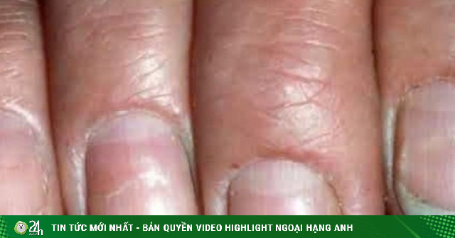 Nhìn móng tay biết bệnh? 6 dấu hiệu cảnh báo sức khỏe bạn không nên bỏ qua