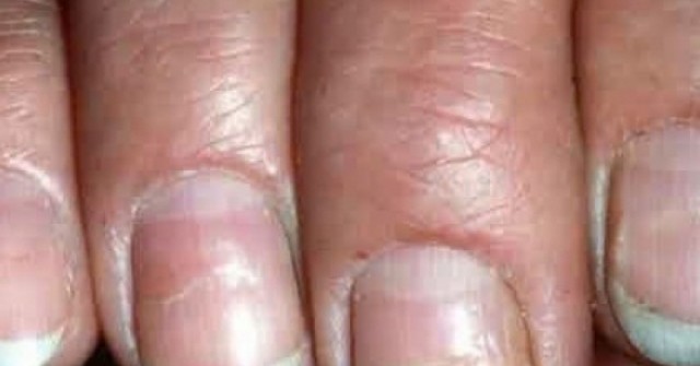 Nhìn móng tay biết bệnh? 6 dấu hiệu cảnh báo sức khỏe bạn không nên bỏ qua