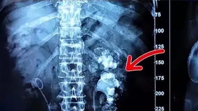Hình ảnh trên phim chụp cho thấy sỏi lấp đầy thận của bệnh nhân. Ảnh: Henan