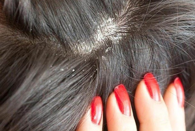 Nhiều người thắc mắc tại sao gội đầu xong vẫn có gàu dù đã dùng dầu gội và vệ sinh tóc đều đặn.