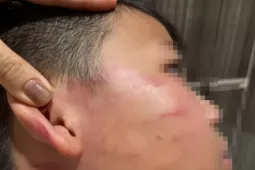 Vụ giáo viên nước ngoài tát học sinh: Gia đình nói bé trai bị thủng màng nhĩ