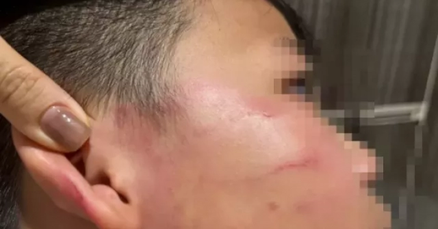 Vụ giáo viên nước ngoài tát học sinh: Gia đình nói bé trai bị thủng màng nhĩ