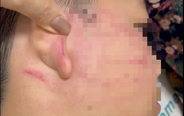 Học sinh lớp 4 bị thầy giáo Ấn Độ tát thủng màng nhĩ