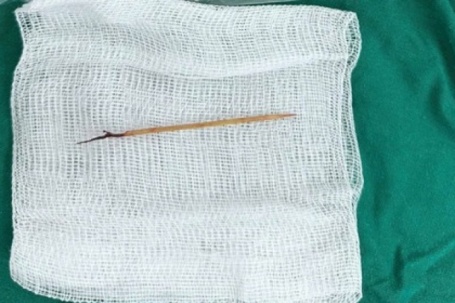 Bác sĩ sốc khi phát hiện chiếc tăm tre cắm trong tim bé trai 13 tuổi