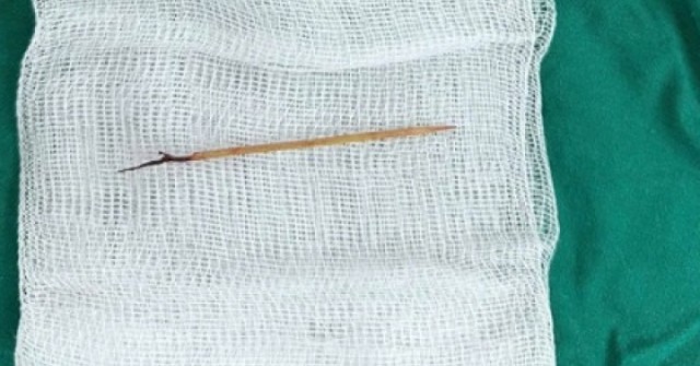 Bác sĩ sốc khi phát hiện chiếc tăm tre cắm trong tim bé trai 13 tuổi