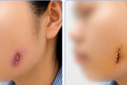 Thủng mặt vì đau răng khôn lâu ngày không điều trị