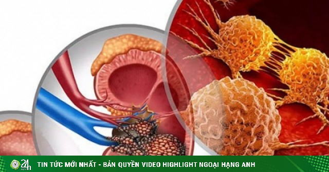 Người đàn ông đang khỏe mạnh bất ngờ phát hiện ung thư thận: Bác sĩ cảnh báo dấu hiệu dễ bị bỏ qua
