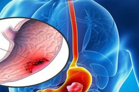 Người phụ nữ 39 tuổi không đau bụng vẫn phát hiện ung thư dạ dày, bác sĩ chỉ ra dấu hiệu ít ai ngờ tới