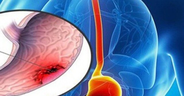 Người phụ nữ 39 tuổi không đau bụng vẫn phát hiện ung thư dạ dày, bác sĩ chỉ ra dấu hiệu ít ai ngờ tới