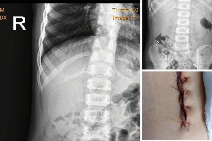 Bệnh viện Sản nhi Nghệ An thông tin về ca mổ lấy dị vật cho trẻ khiến cộng đồng mạng "dậy sóng" bất bình