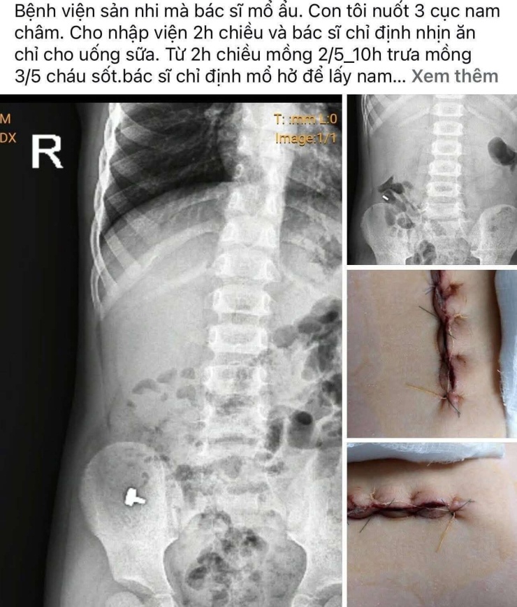 Thông tin về ca phẫu thuật của bệnh nhi được đăng tải lên mạng xã hội thu hút sự quan tâm đặc biệt của dư luận. Ảnh chụp màn hình&nbsp;