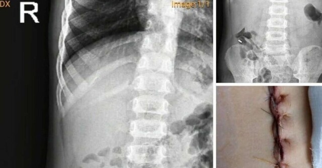 Bệnh viện Sản nhi Nghệ An thông tin về ca mổ lấy dị vật cho trẻ khiến cộng đồng mạng "dậy sóng" bất bình