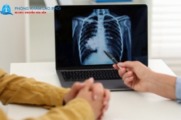 Phác đồ điều trị lao phổi chuẩn Bộ Y tế: Tuân thủ đúng để tránh lao kháng thuốc