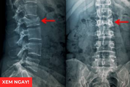 Tin tức sức khỏe - 3 tư thế ngủ tốt nhất giúp giảm đau rõ rệt cho người bị thoái hóa cột sống, thoát vị đĩa đệm