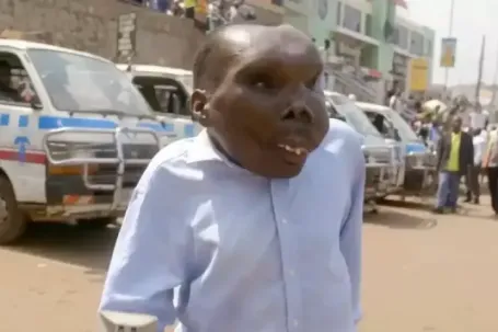 Người đàn ông mắc bệnh hiếm đổi đời nhờ mang danh 'xấu nhất thế giới'