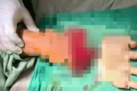 Nối thành công bàn tay đứt lìa của nam thanh niên