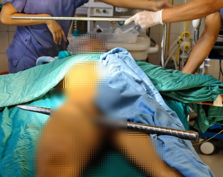 Dị vật xuyên từ mặt trong ra mặt trước ngoài đùi.&nbsp;Ảnh BVCC