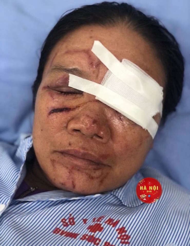 Theo chia sẻ từ gia đình, hiện tinh thần của mẹ em vẫn còn hoảng loạn, sức khỏe suy giảm sau sự việc xảy ra. Vùng mắt bị tổn thương và đã được khâu 5 mũi, hiện vẫn chưa thể mở mắt bình thường.