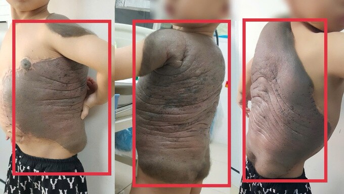 Khối u lớn khiến bé trai 7 tuổi như mang 'mai rùa' trên lưng. Ảnh: Bệnh viện Bệnh Nhiệt đới Trung ương