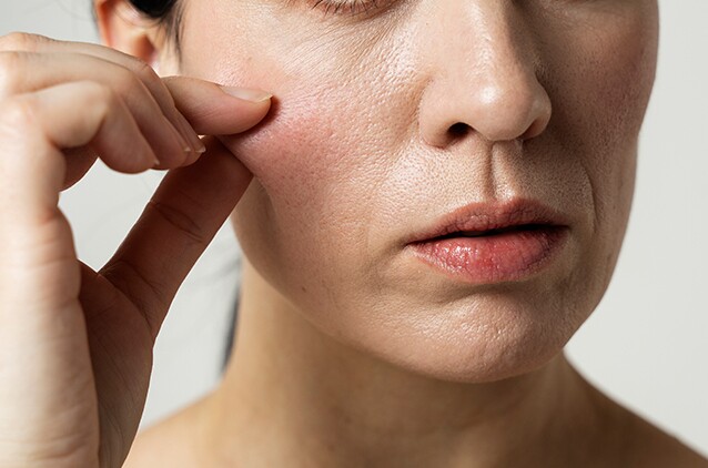 Sự suy giảm collagen là một trong những nguyên nhân chính khiến làn da lão hóa, mất độ săn chắc và xuất hiện nếp nhăn. Ảnh: kosmoderma