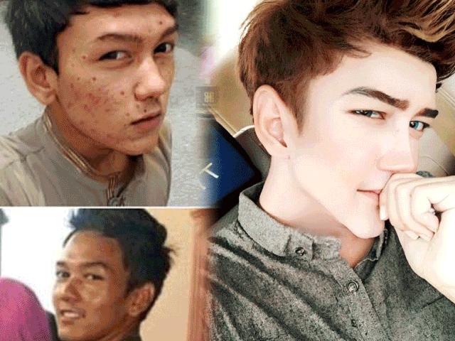 Sốc vì mặt mụn chi chít trước ”dao kéo” của hot boy Malaysia