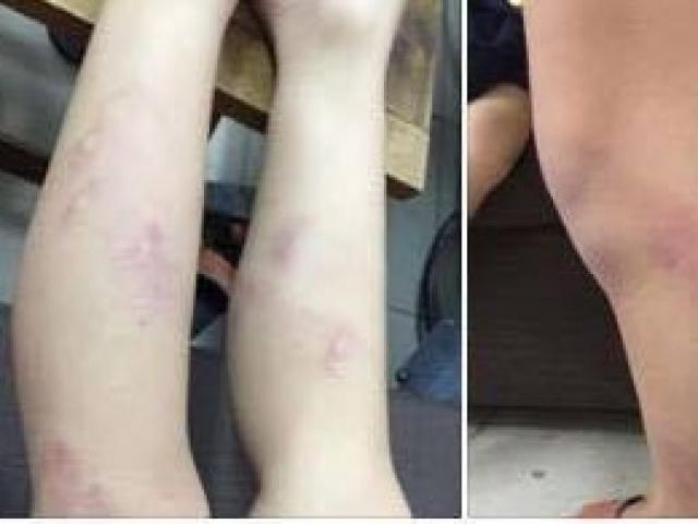 Kỷ luật cảnh cáo nữ giáo viên đánh 11 học sinh bầm tím