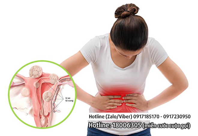 Đau đớn bất thường ở vùng bụng - Cẩn trọng với căn bệnh u xơ tử cung - 1