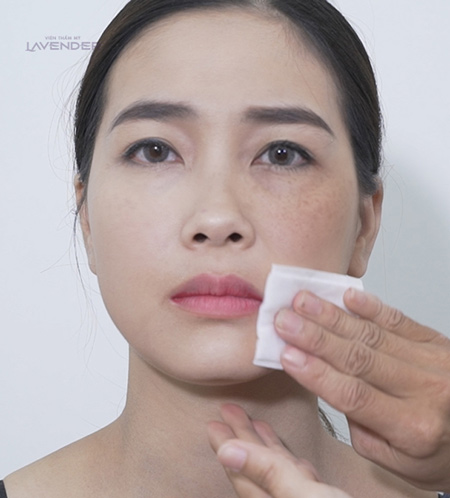 Bộ ảnh chứng minh sức tàn phá của nám với nhan sắc người phụ nữ - 1