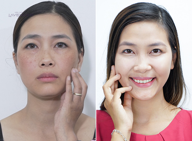 Bộ ảnh chứng minh sức tàn phá của nám với nhan sắc người phụ nữ - 2