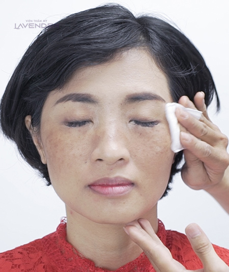 Bộ ảnh chứng minh sức tàn phá của nám với nhan sắc người phụ nữ - 3