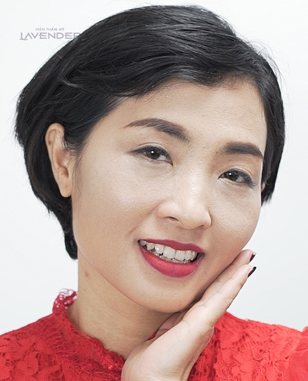 Bộ ảnh chứng minh sức tàn phá của nám với nhan sắc người phụ nữ - 4